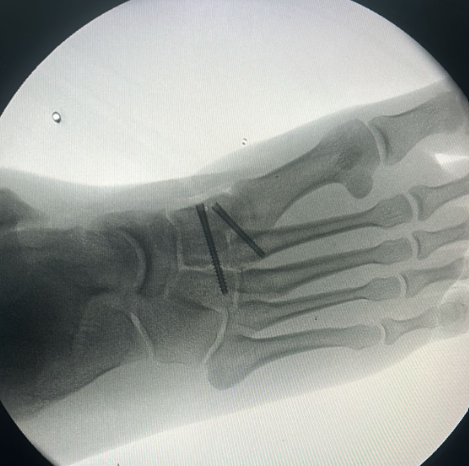 Ayak cerrahisi görseli