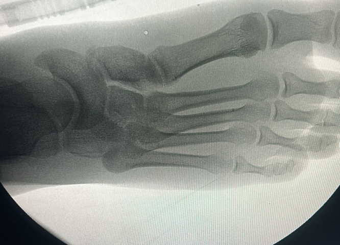 Ayak cerrahisi görseli 2