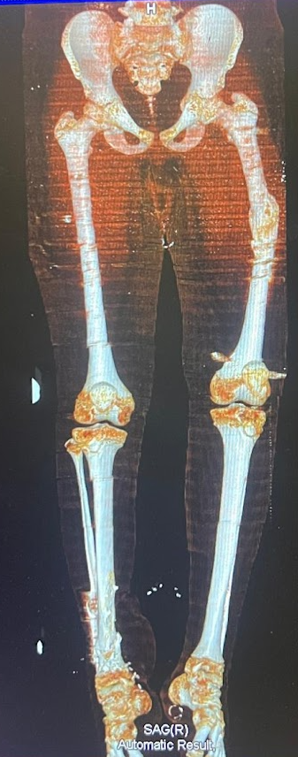 Travma Sonrası Kırık Cerrahisi
