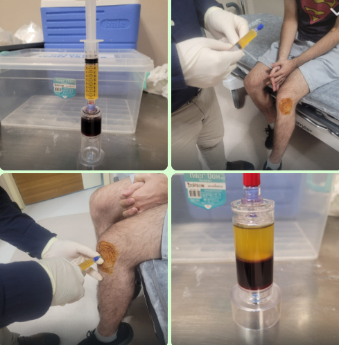 PRP uygulaması görseli