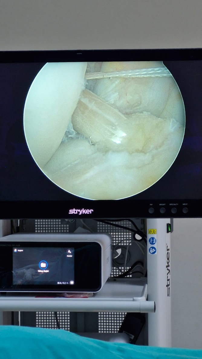 Ön Çapraz Bağ Ameliyatı (Artroskopi) Görüntüsü