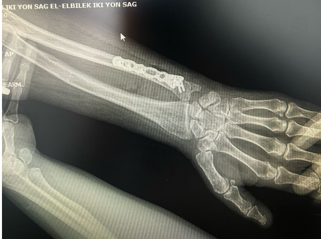 Ön Kol kırık ameliyatı