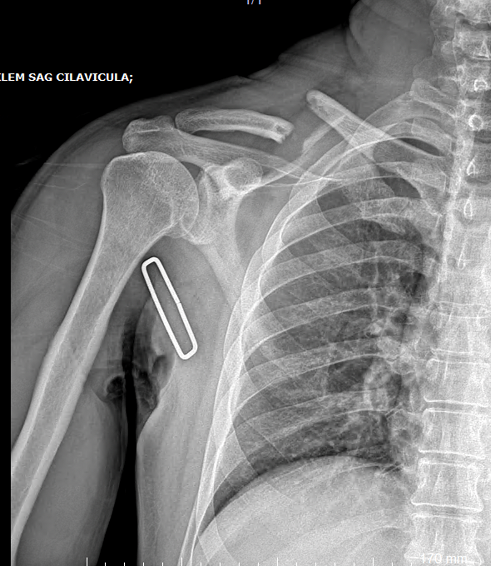 Klavikula kırık ameliyatı