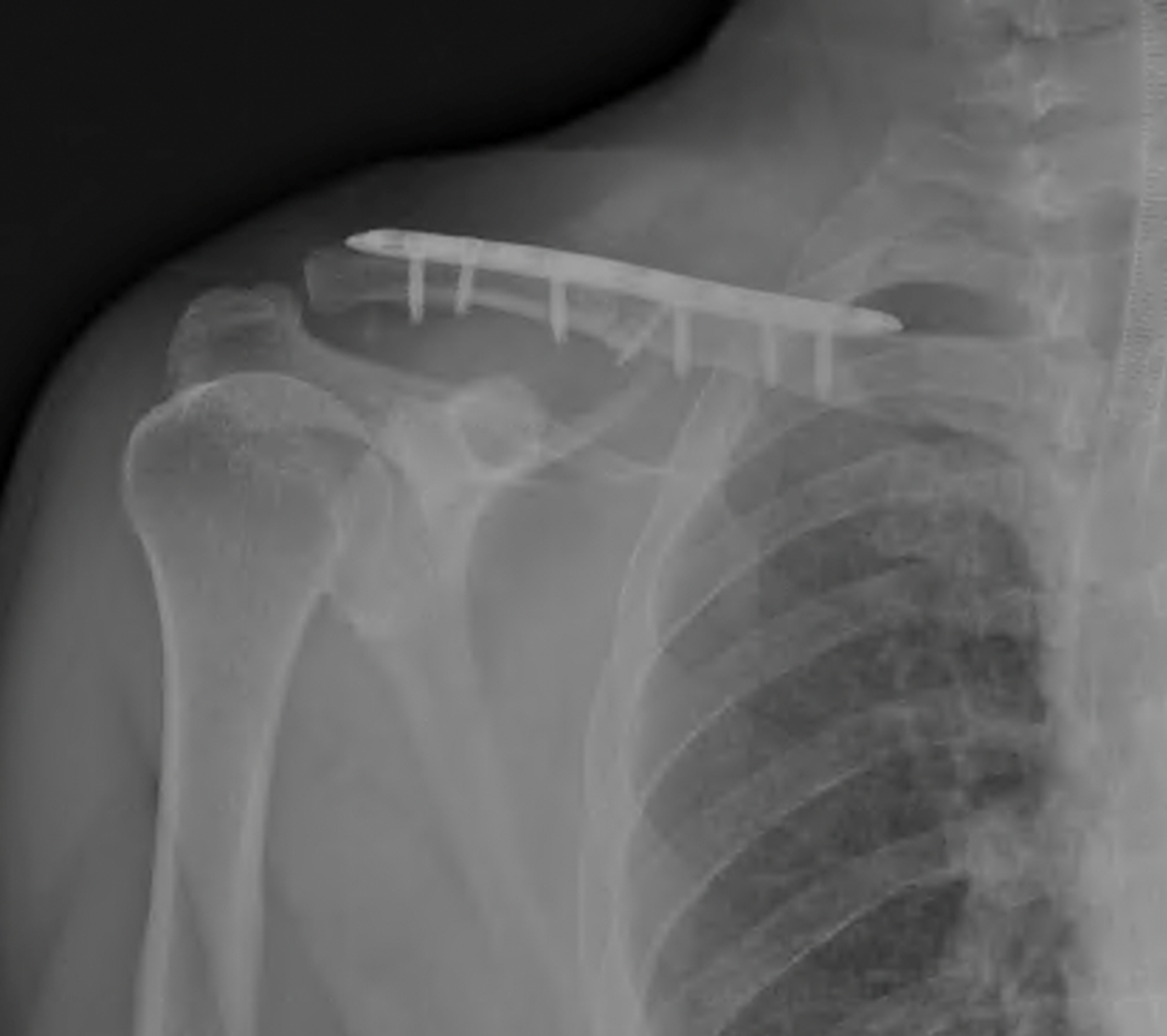 Klavikula kırık ameliyatı