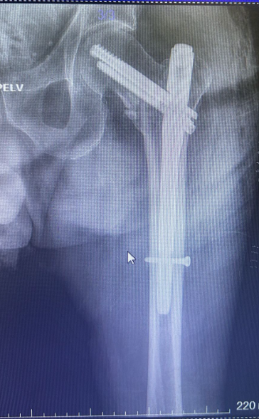 Kalça kırık ameliyatı