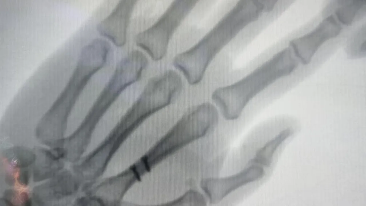 El Cerrahisi ve Mikrocerrahi: İş Kazalarında Acil Çözümler