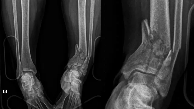 Travma Sonrası Kırık Cerrahisi: 7/24 Acil Müdahale