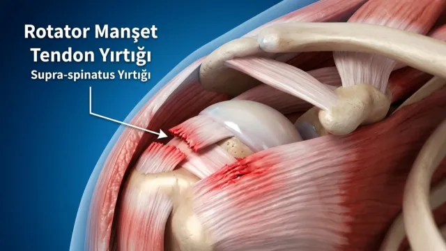 Omuz Kas Yırtığı (Rotator Cuff) ve Ameliyatı